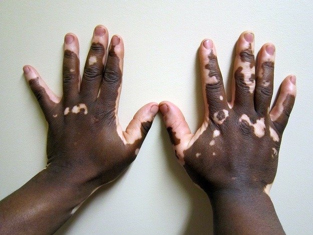Vitiligo Nedir ?